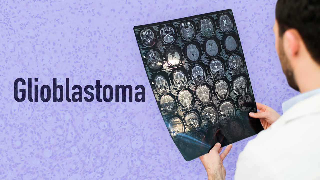Cover image for: Nursing Care of Glioblastoma