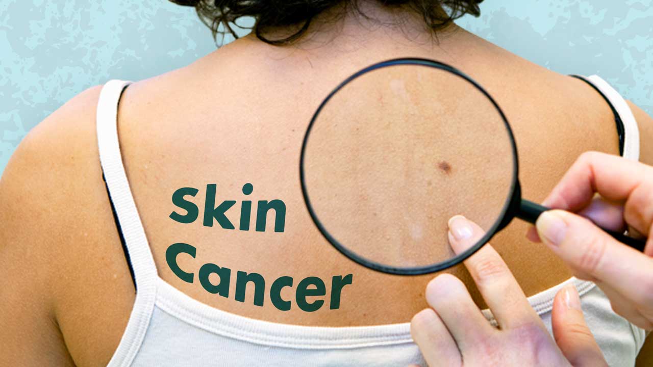 Cover image for: Focus on Skin Cancer: An Overview