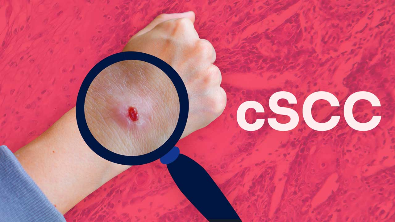 Cover image for: Cutaneous Squamous Cell Carcinoma (cSCC): Dysplasia to Invasion