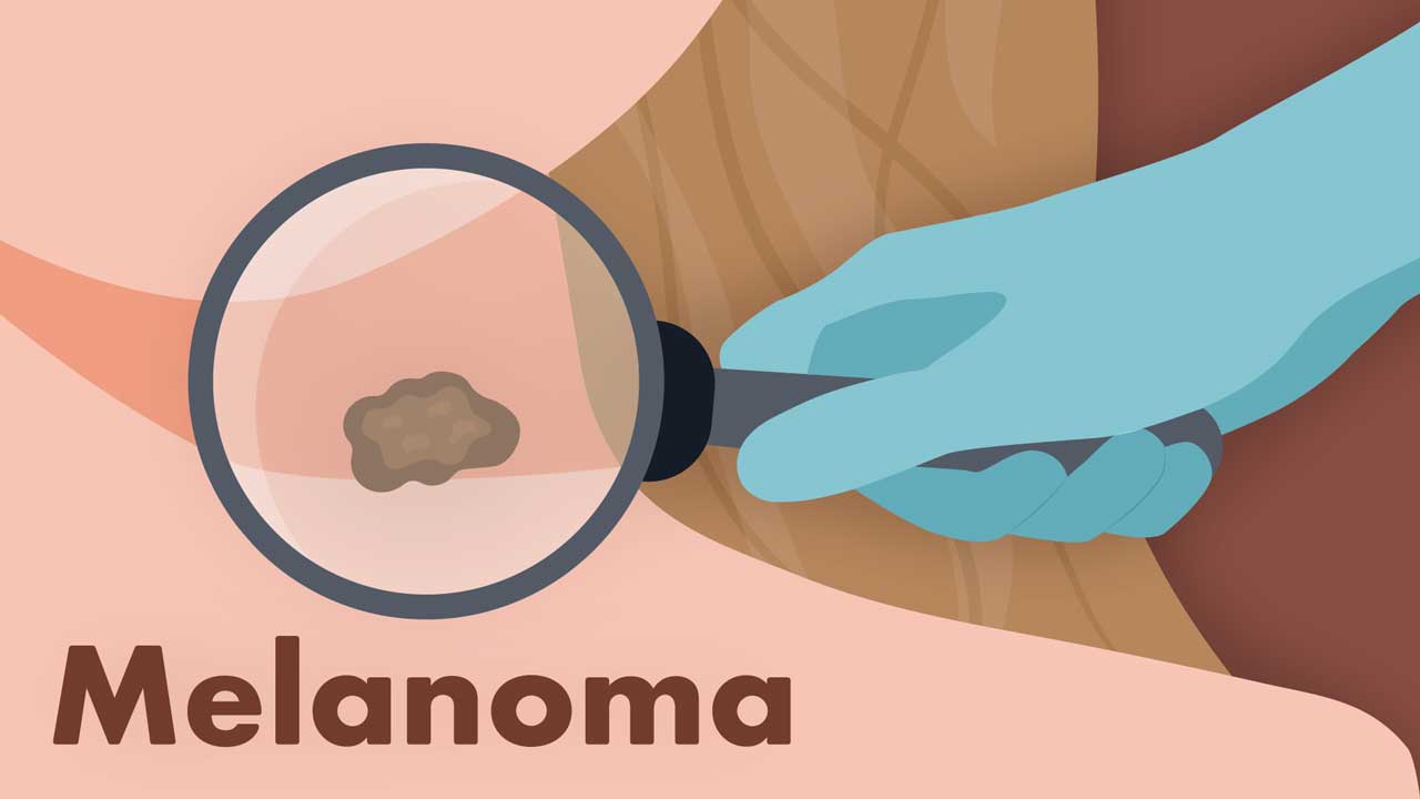 Cover image for: Recognising Melanoma 