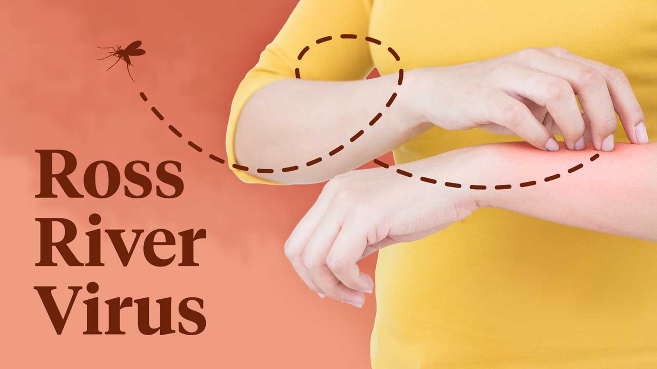 Cover image for: Are You Familiar With the Risks of Ross River Virus Infection?