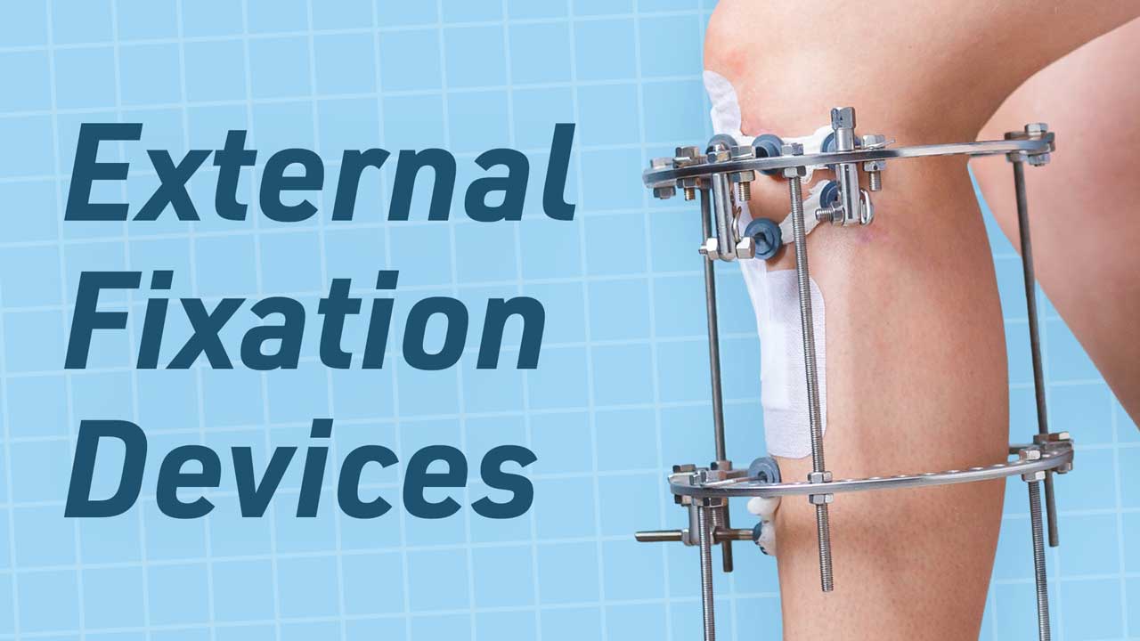 Cover image for: The Care of External Fixation Devices