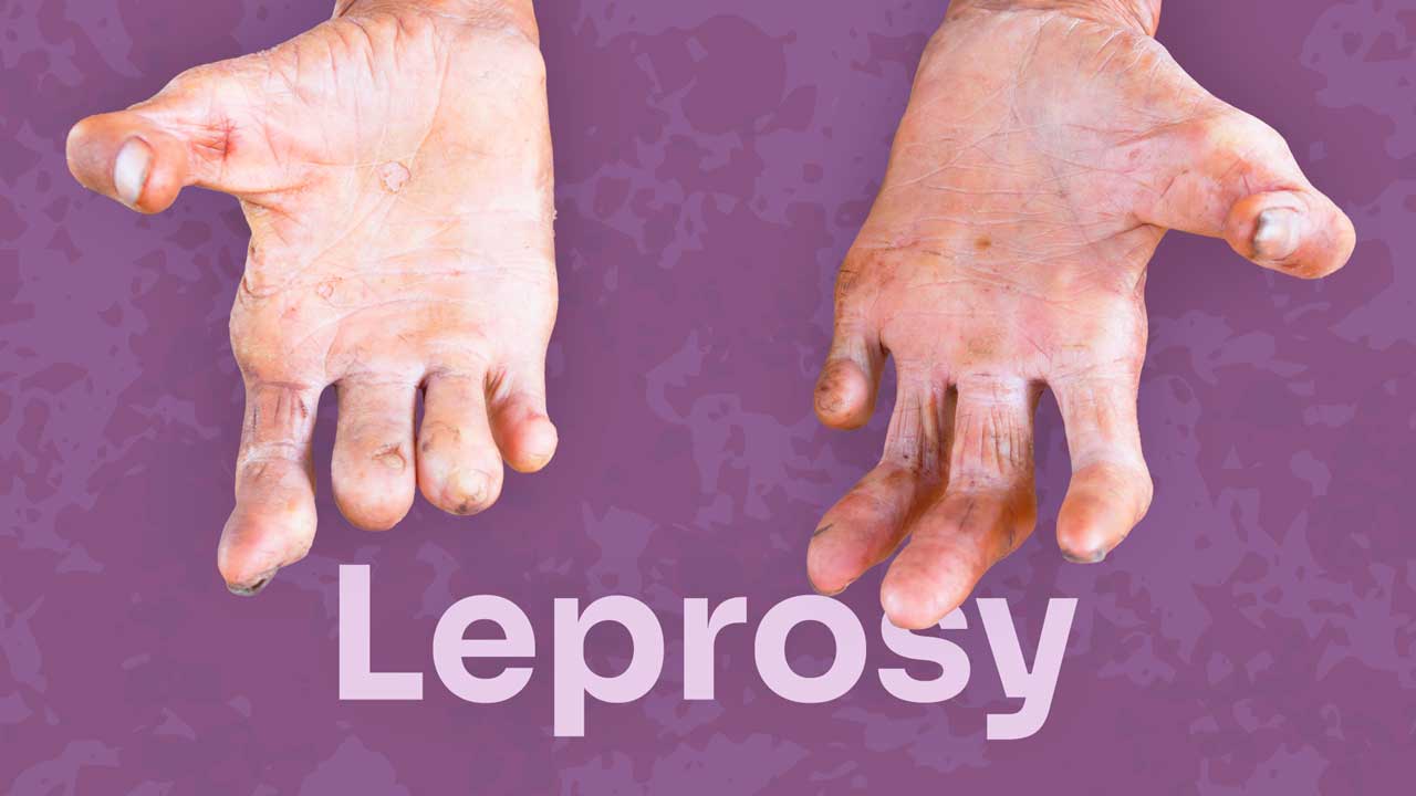 Cover image for: Leprosy: How Much do You Really Know?
