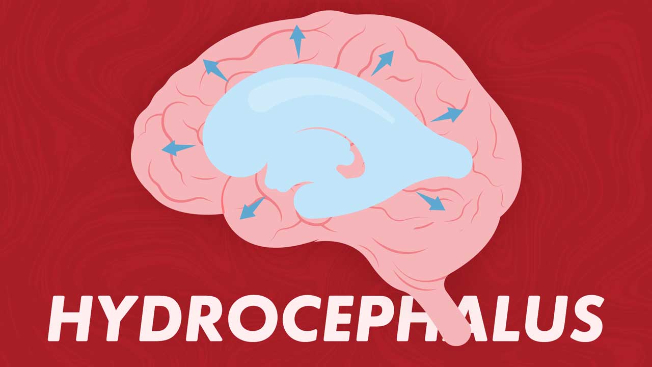 Cover image for: Hydrocephalus and Shunts