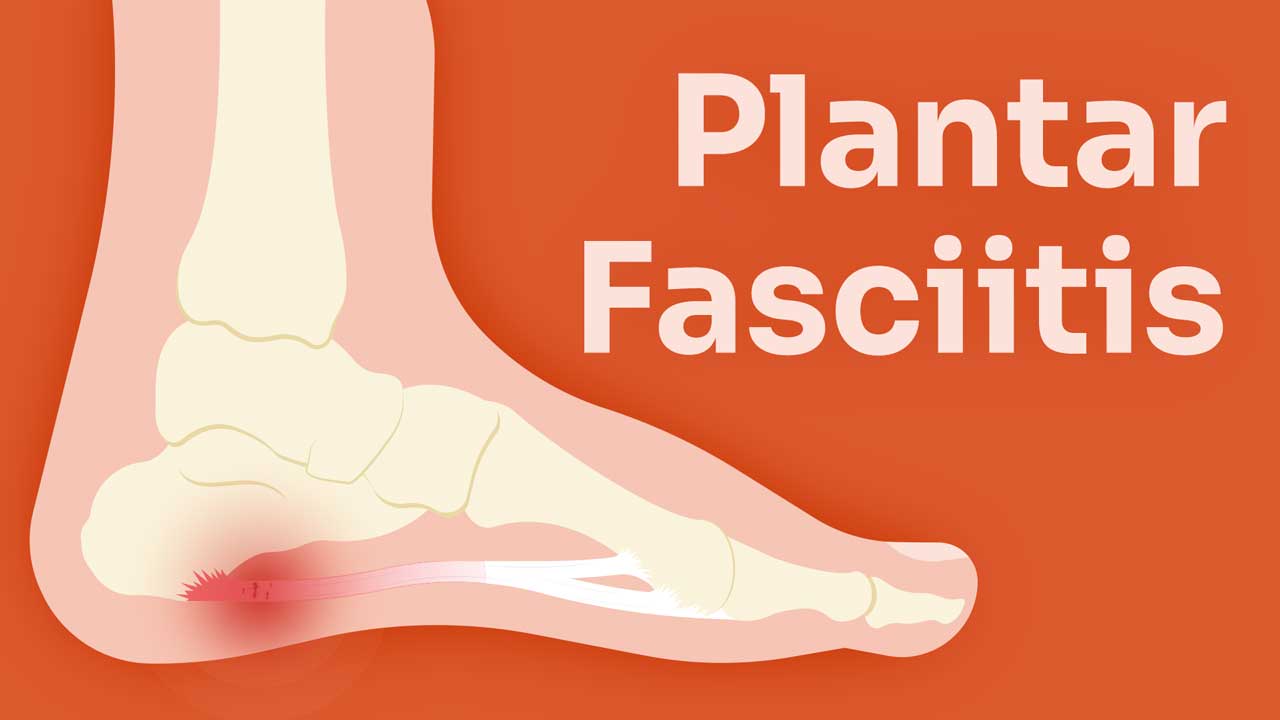 Cover image for: Plantar Fasciitis and Foot Pain in Nursing