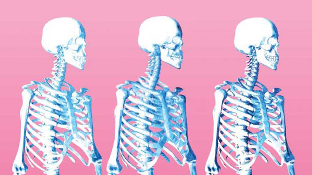 Cover image for: Osteogenesis Imperfecta: Fragile Bones