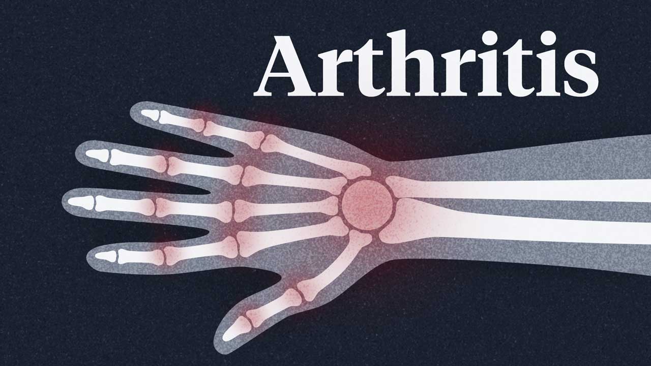 Cover image for: A Big Picture Look at Arthritis in Australia