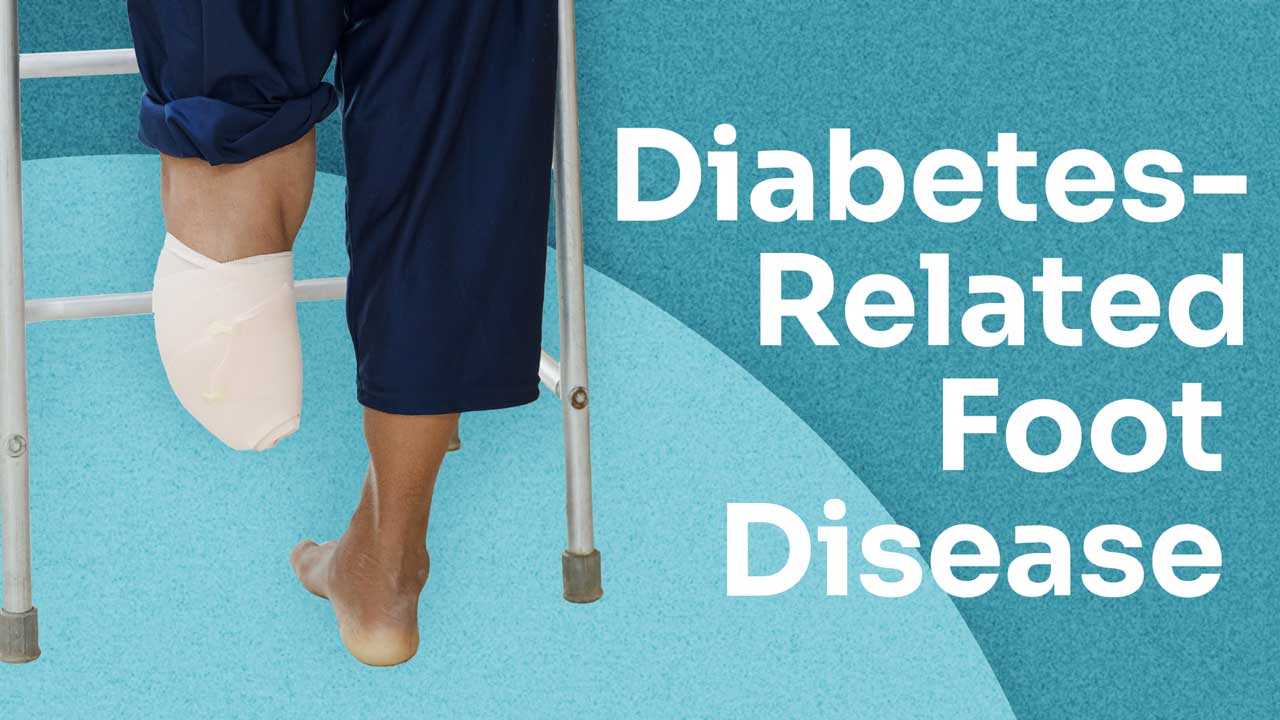 Cover image for: Diabetes-Related Foot Disease Explained