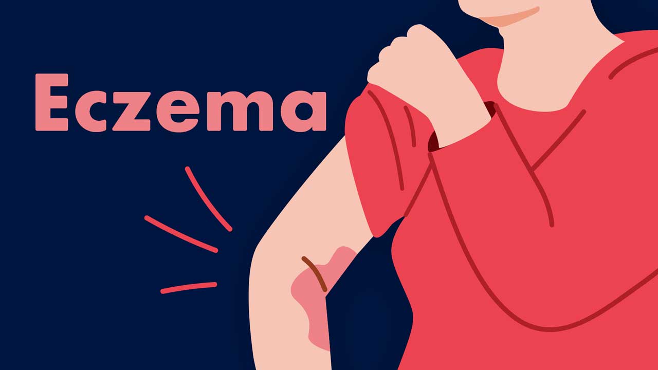 Cover image for: Eczema Symptoms and Management