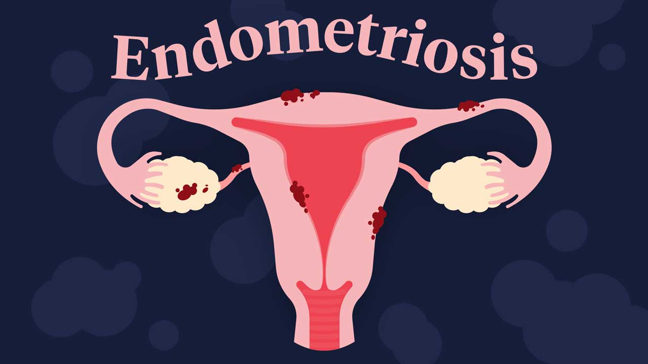 Cover image for: Examining Endometriosis