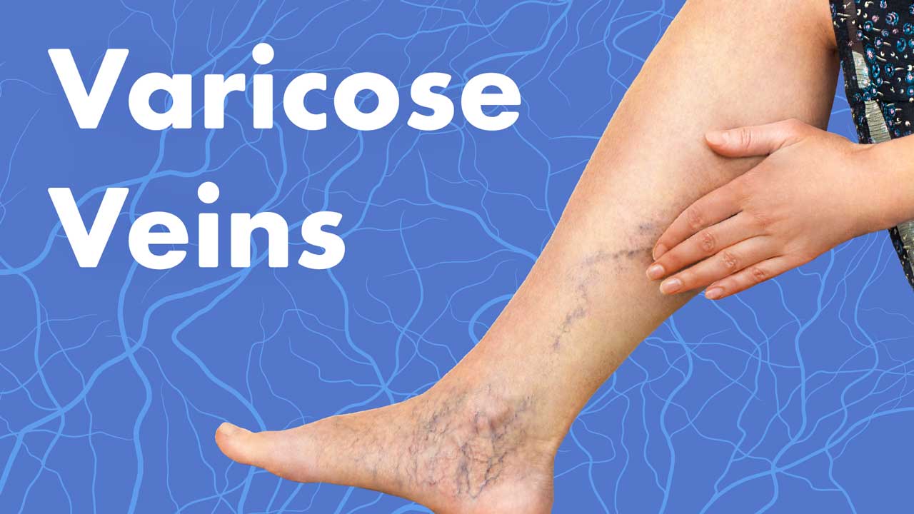 Cover image for: Varicose Veins: Complications, Treatment and Prevention
