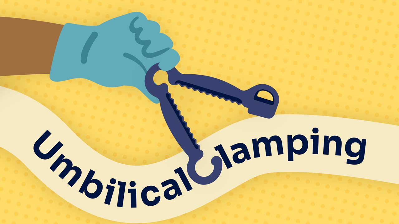 Cover image for: Umbilical Cord Clamping: How Long Should You Wait?
