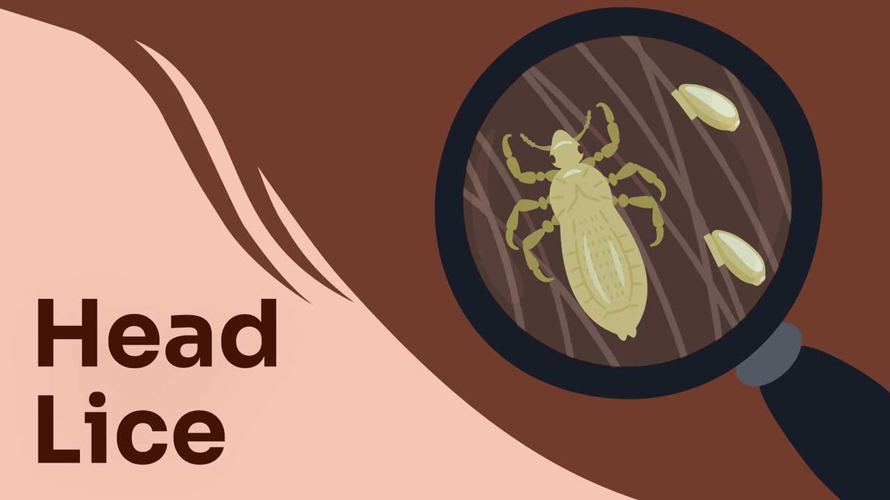 Cover image for: Head Lice: What They Are and How to Get Rid of Them