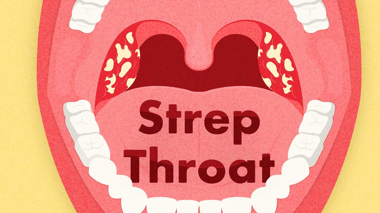 Cover image for: All About Strep Throat