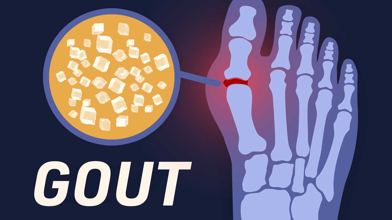Cover image for: Gaining an Understanding of Gout