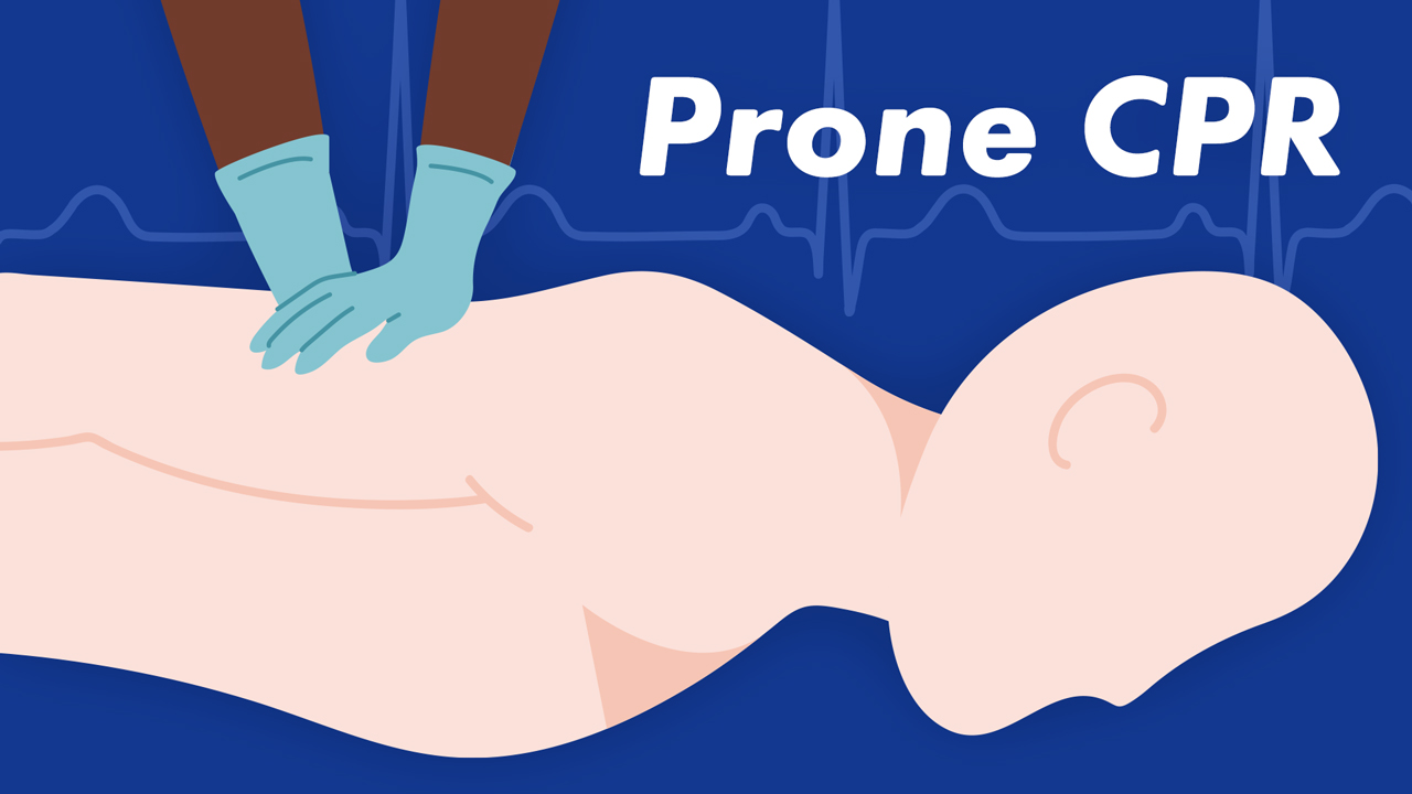 Cover image for: Performing CPR on Prone Position Patients