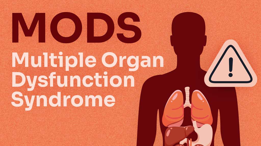 Cover image for: An Overview of Multiple Organ Dysfunction Syndrome
