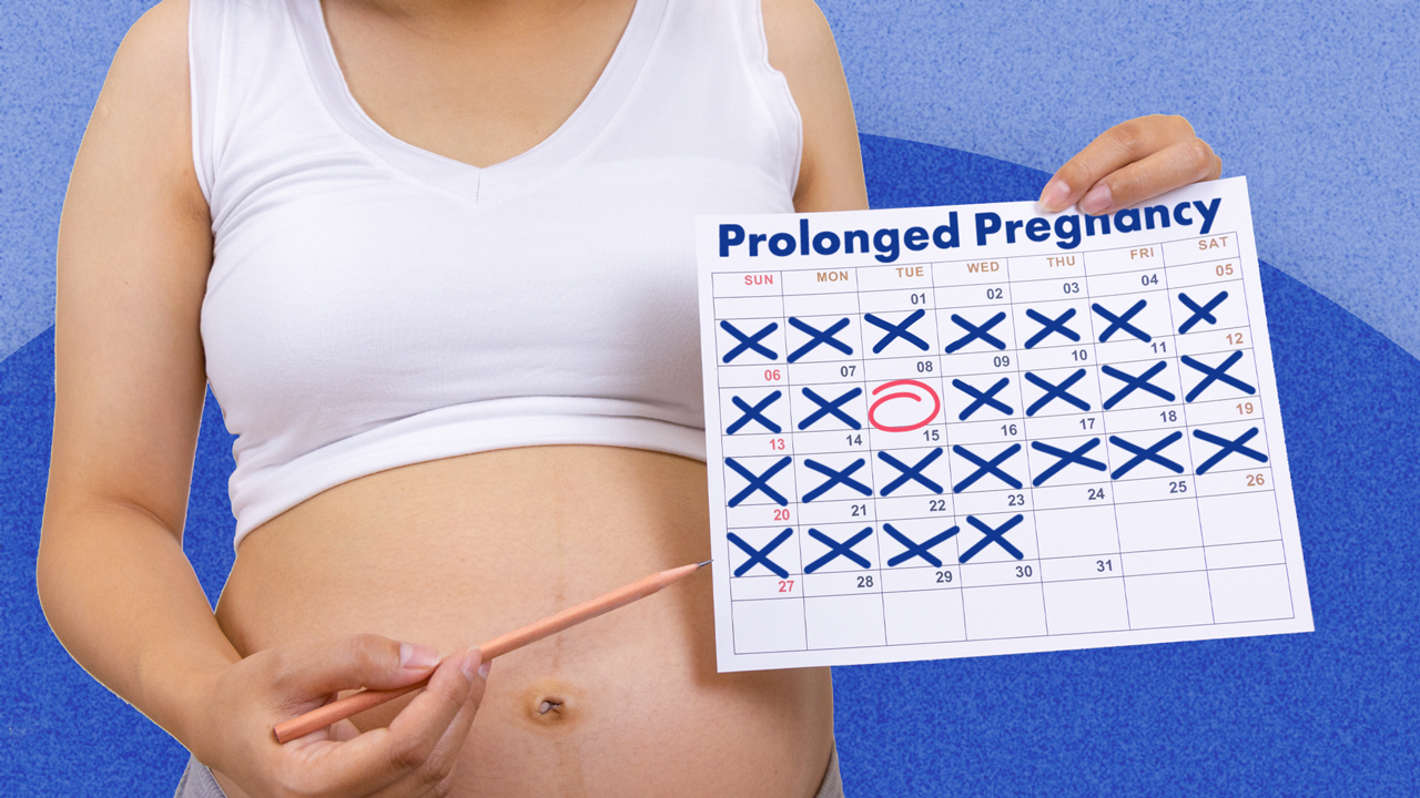 Cover image for: Prolonged Pregnancy