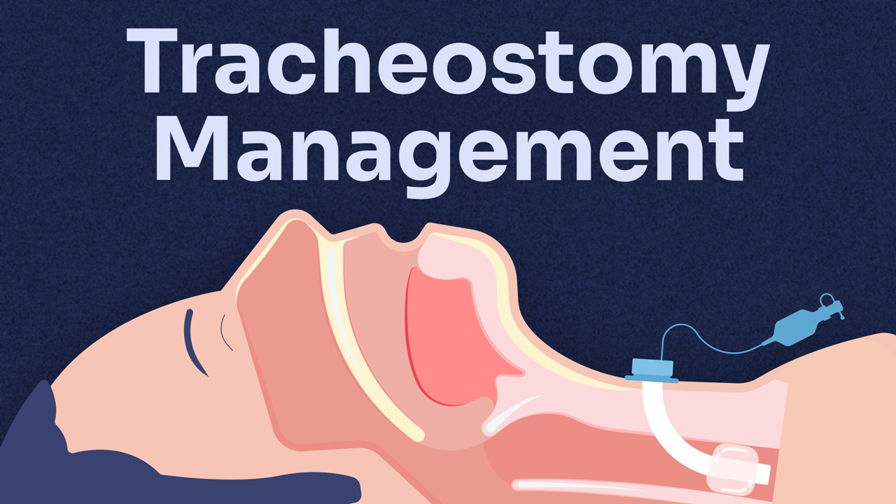 Cover image for: Tracheostomy Management