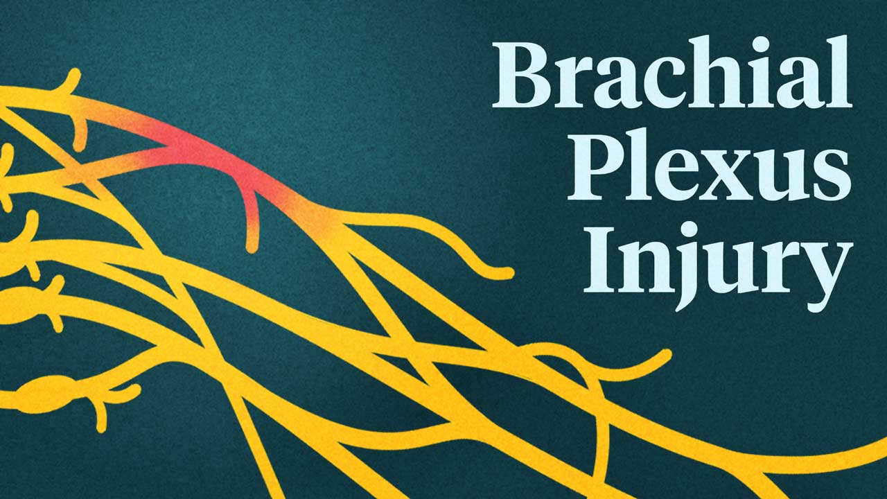 Cover image for: Brachial Plexus Injuries: Care and Treatment