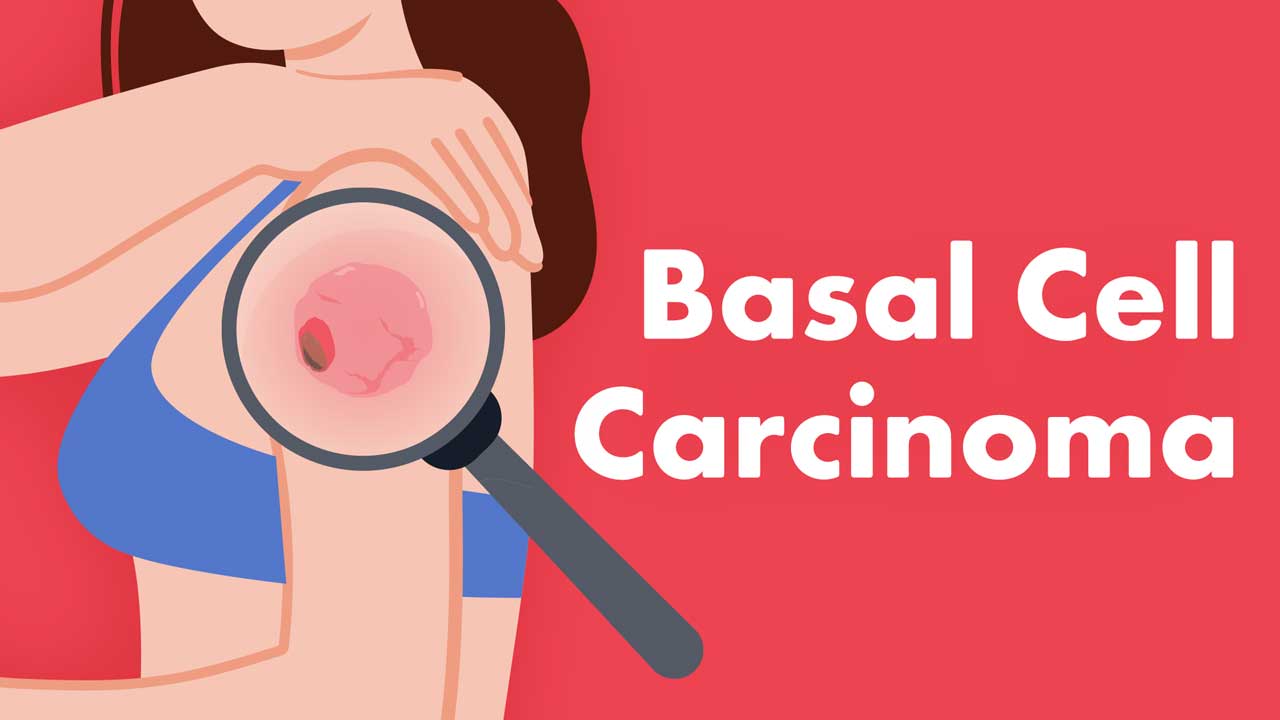 Cover image for: Basal Cell Carcinoma (BCC): Is it on Your Radar?