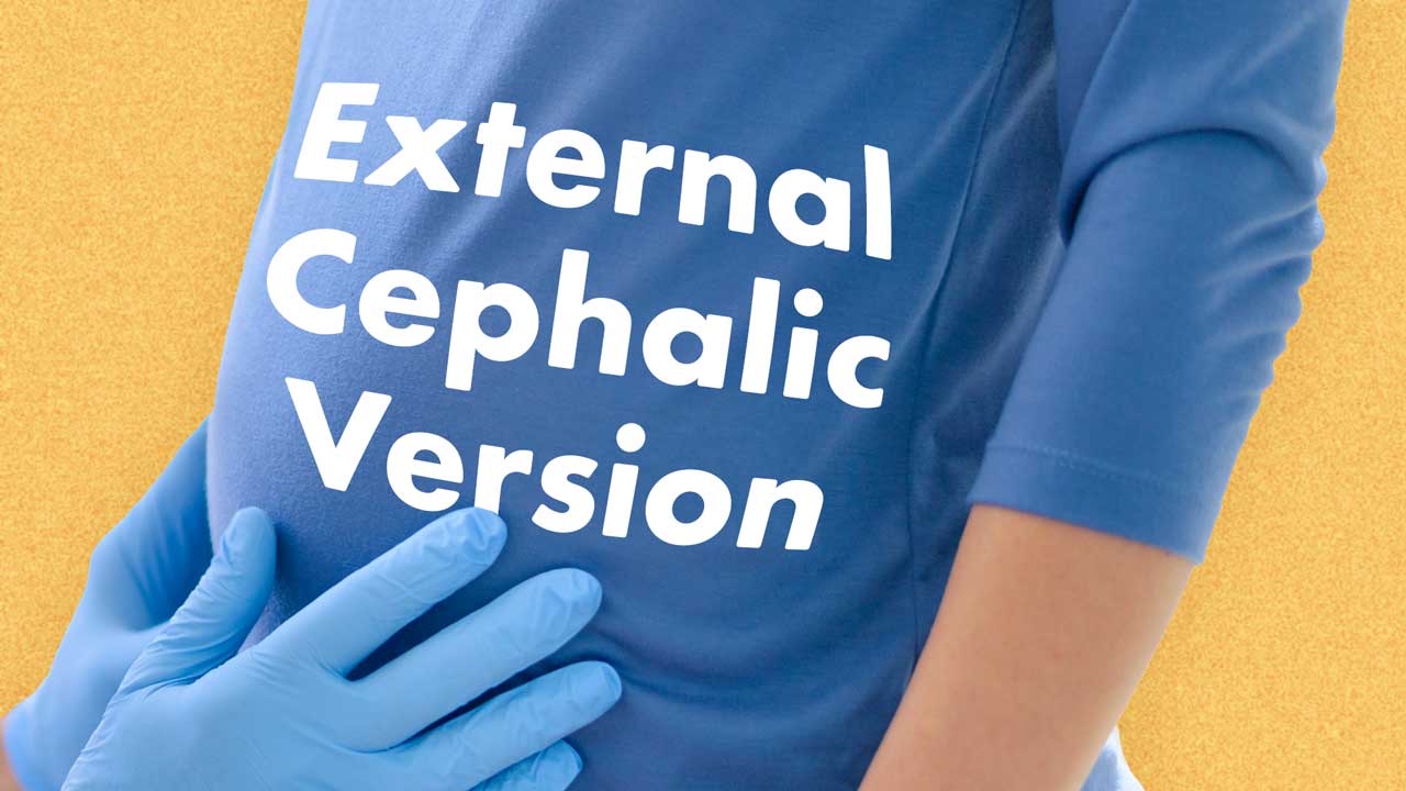 Cover image for: Evaluating External Cephalic Version   