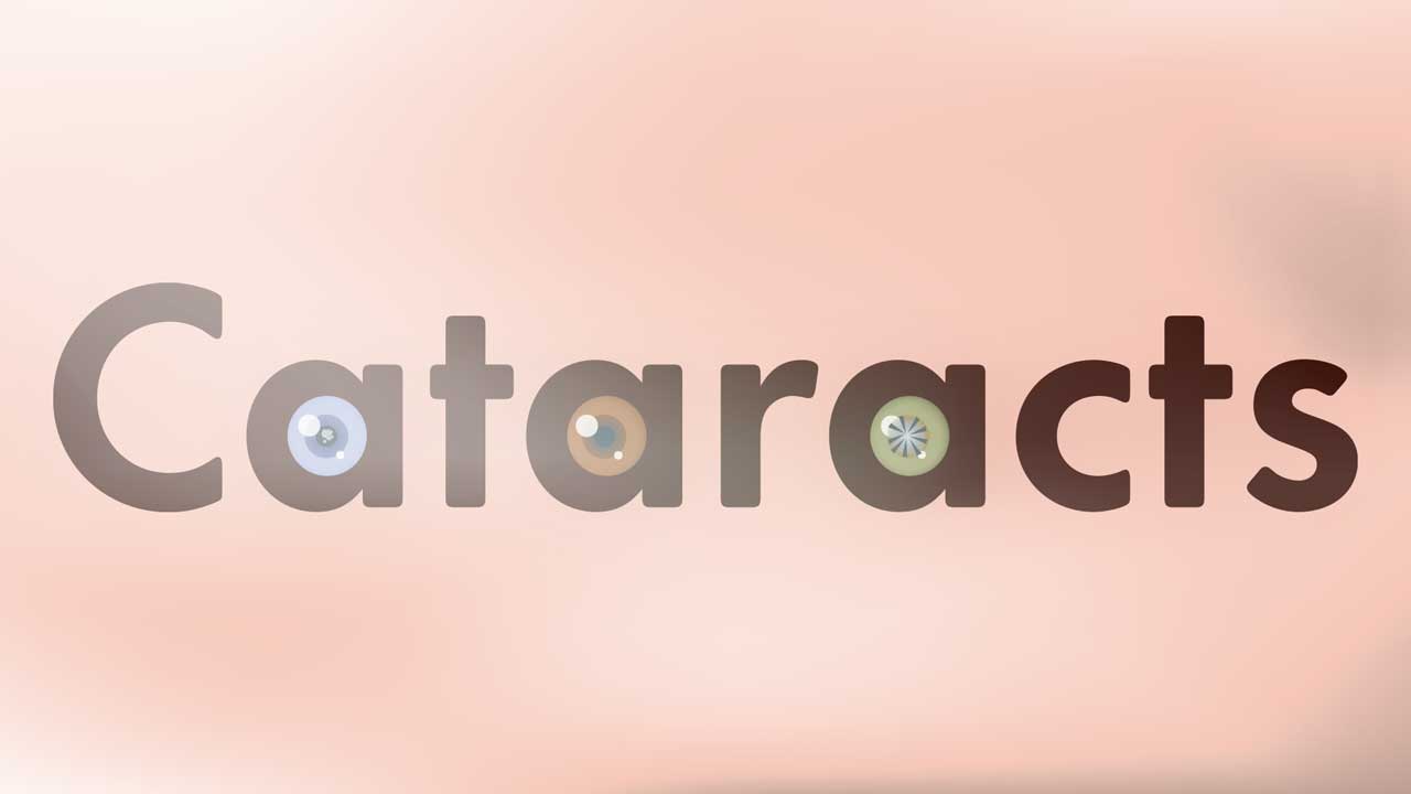 Cover image for: Causes of Cataracts and Why They're so Common