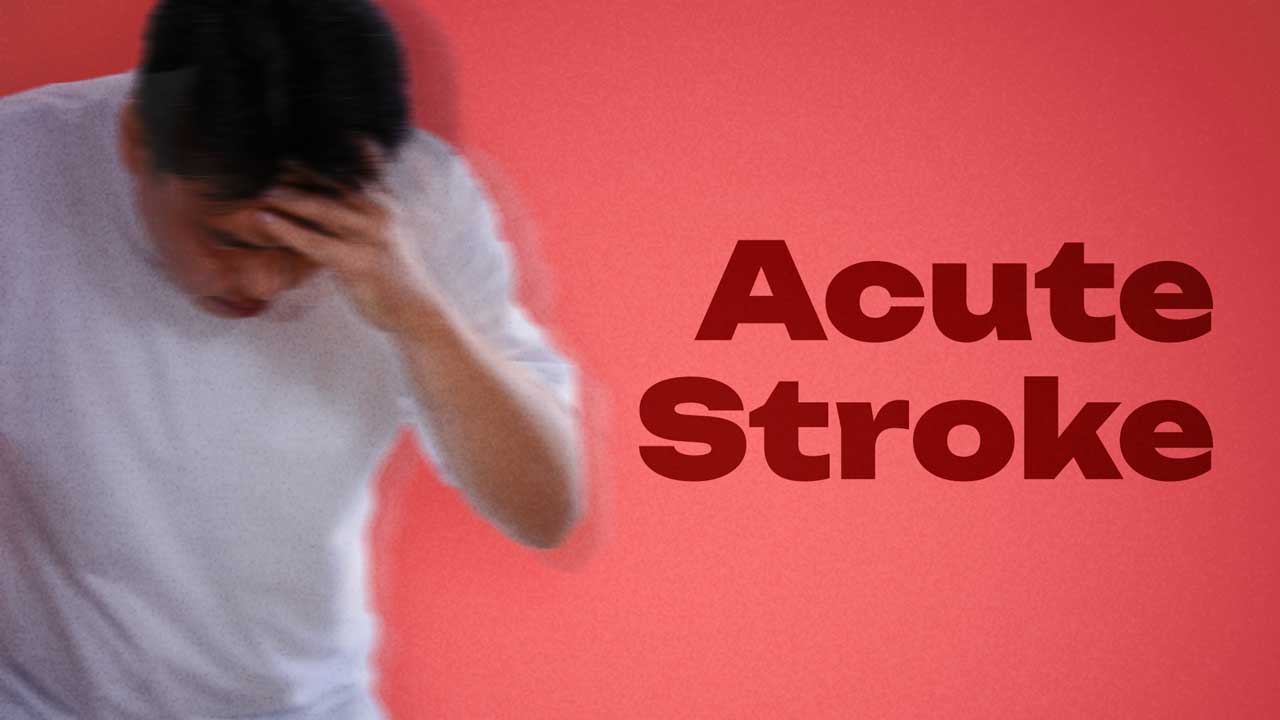 Cover image for: Clinical Management of Acute Stroke