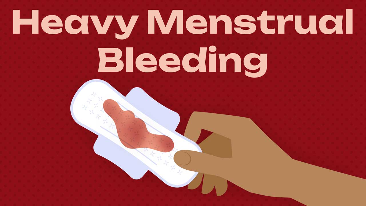 Cover image for: Managing Heavy Menstrual Bleeding