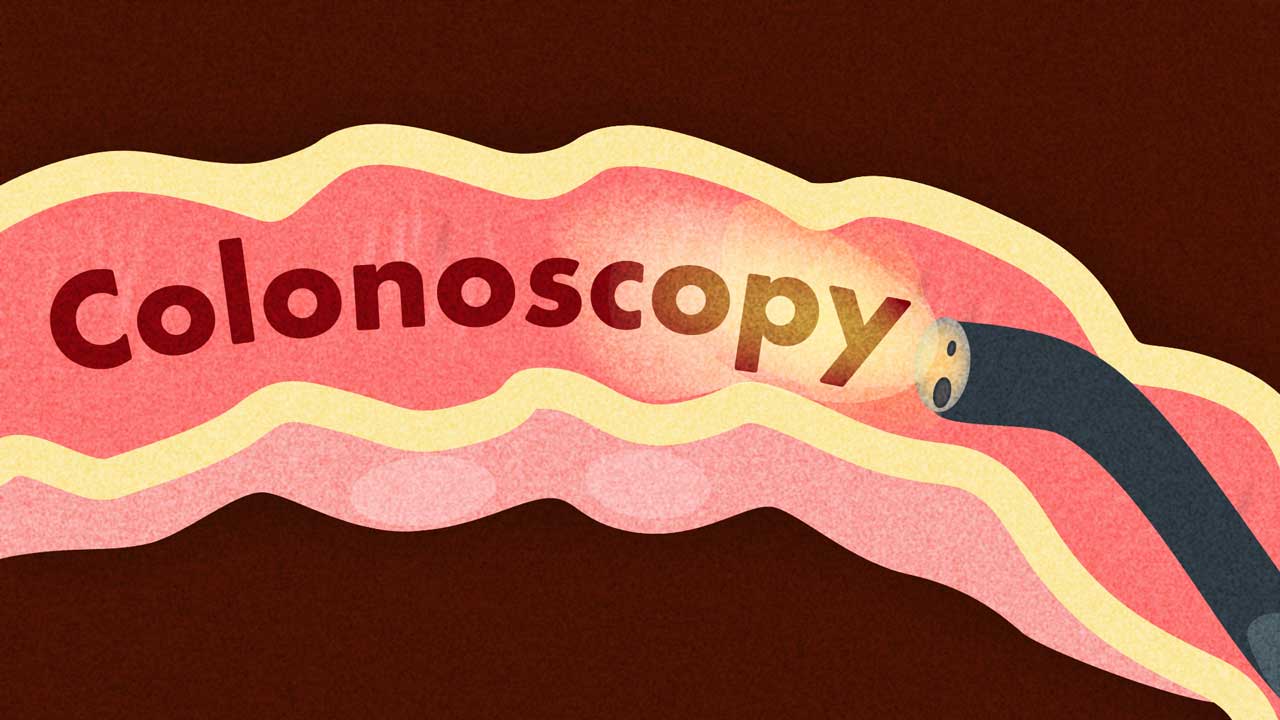 Cover image for: Colonoscopy Procedures and Standards