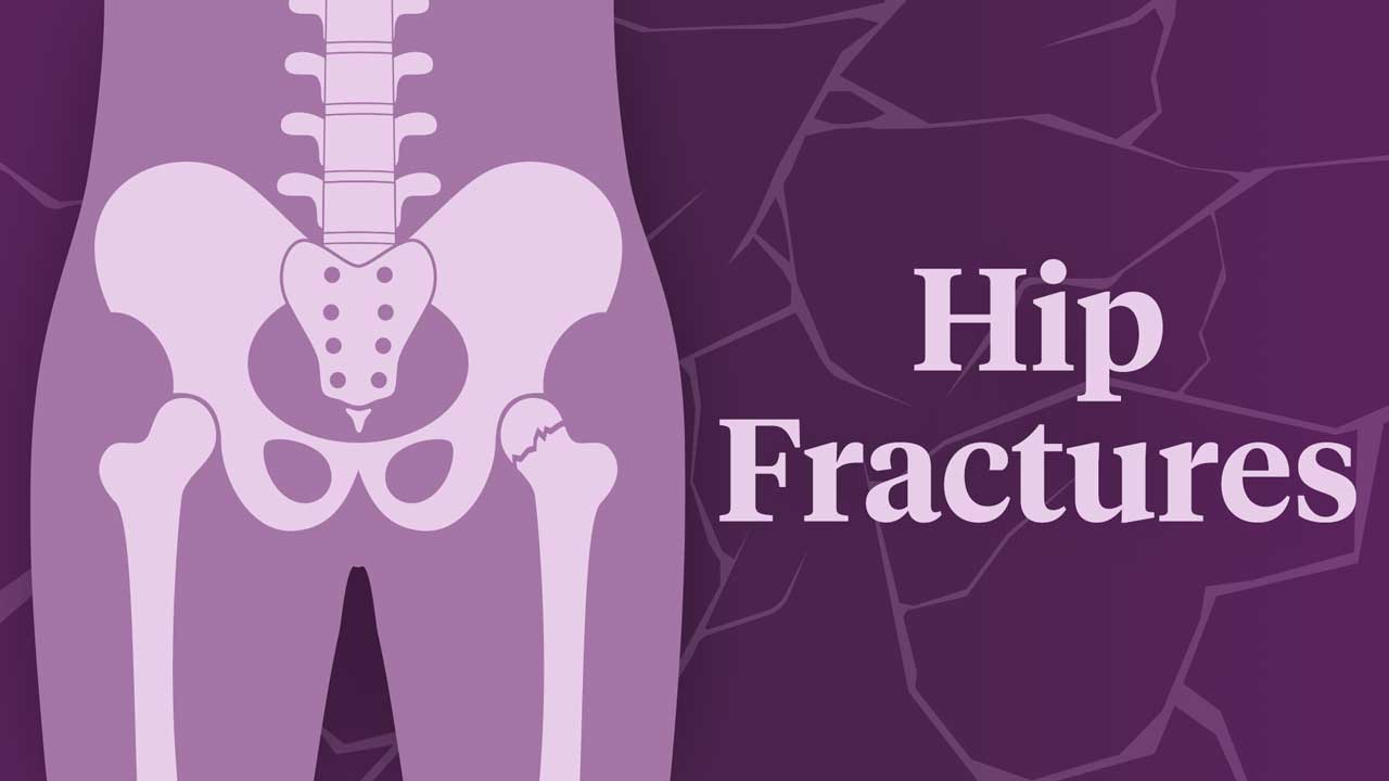 Cover image for: Preventing and Treating Hip Fractures