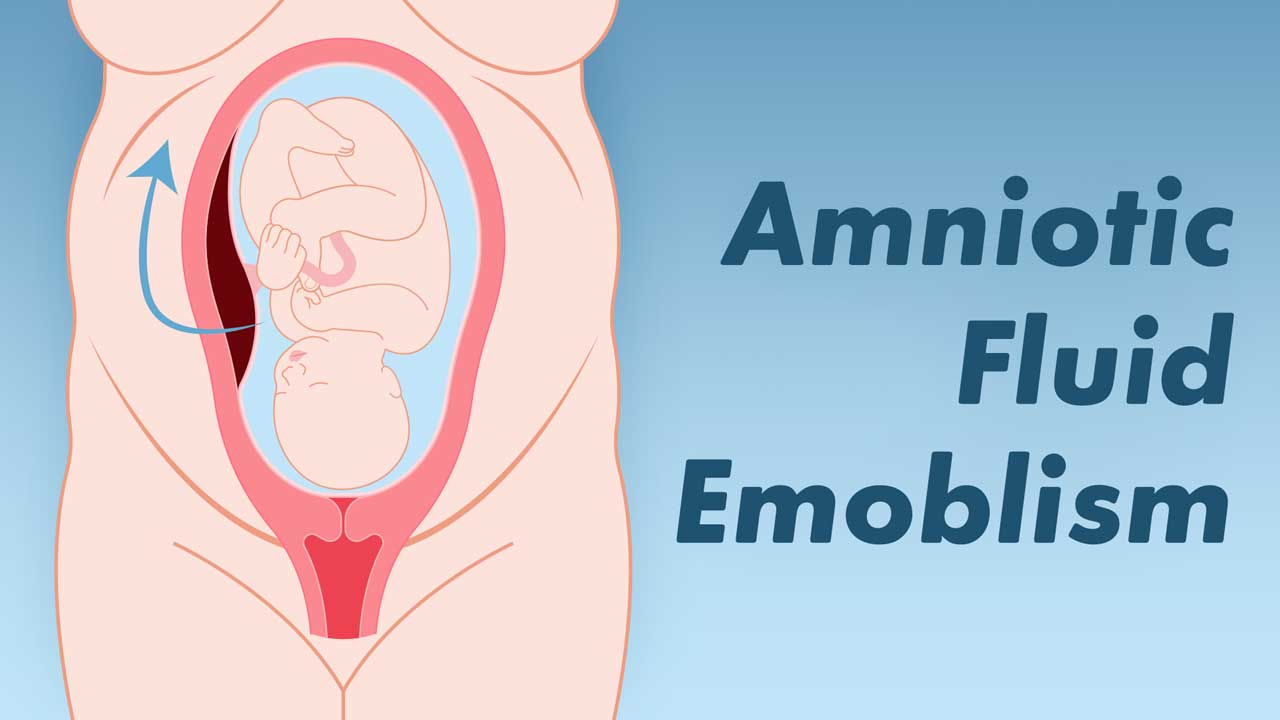 Cover image for: An in-Depth Look at Amniotic Fluid Embolism
