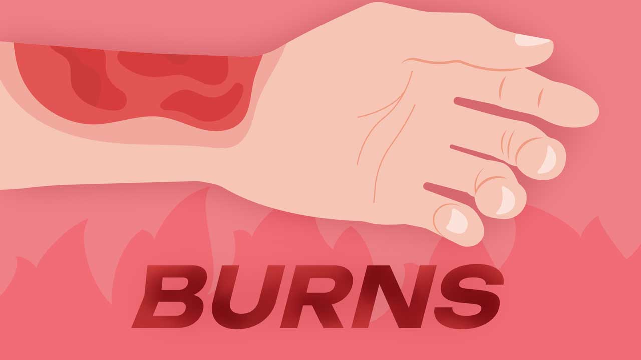Cover image for: Acute Management of Burn and Scald Injuries in Adults