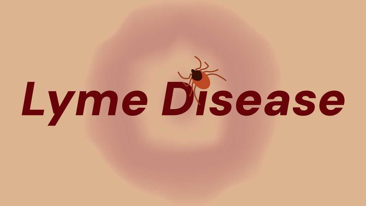 Cover image for: Lyme Disease