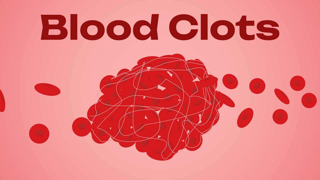 Image for An Introduction to Blood Clots