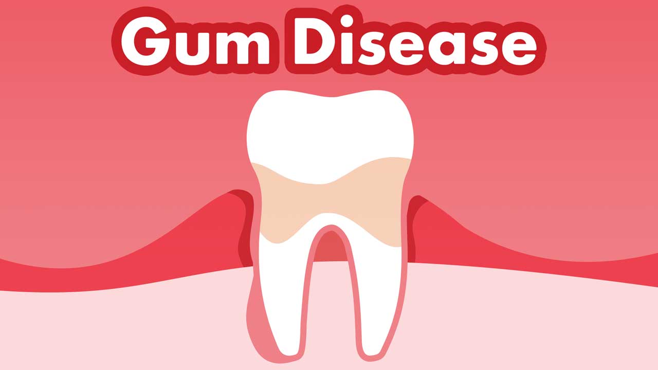 Image for Gum Disease (Gingivitis and Periodontitis)