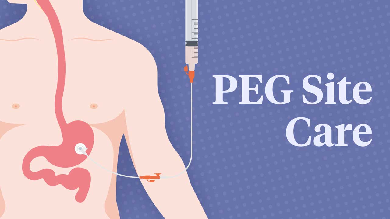 Image for Percutaneous Endoscopic Gastrostomy (PEG) Site Care