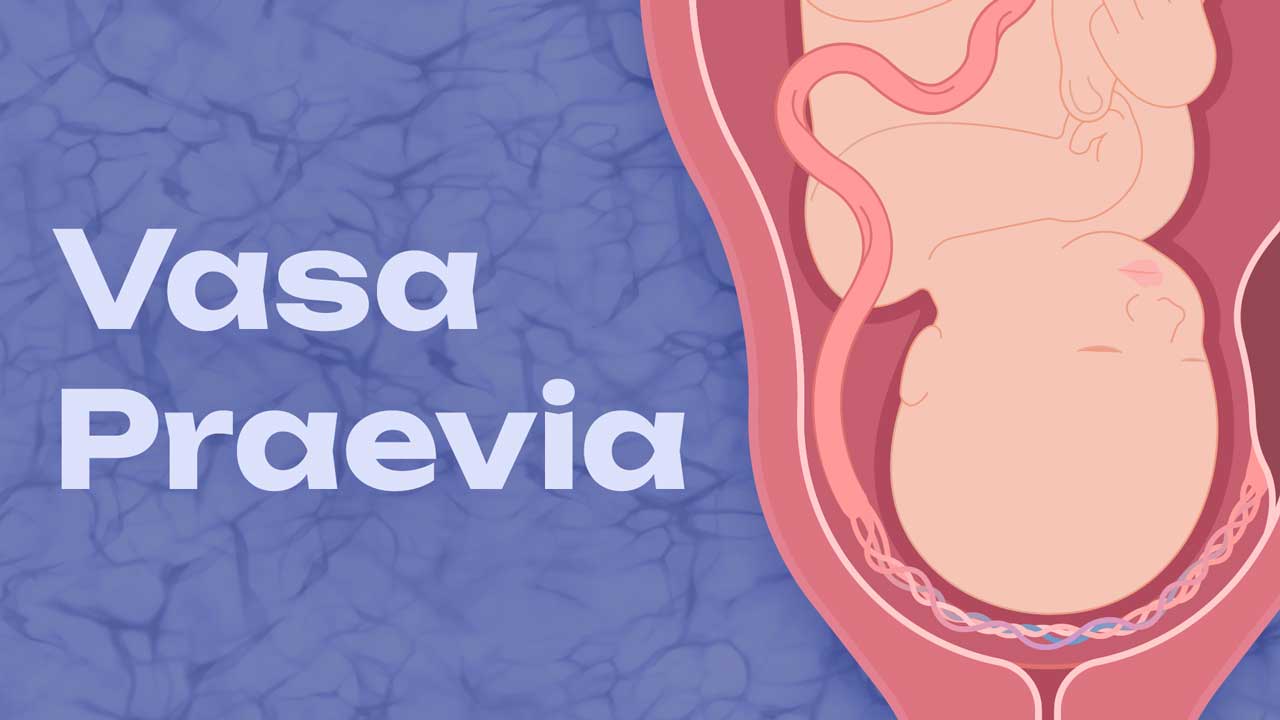 Cover image for: Understanding Vasa Praevia