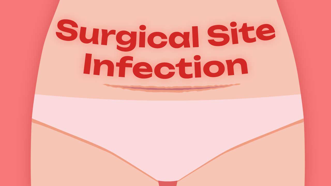 Cover image for: Preventing Surgical Site Infection Post-caesarean Birth