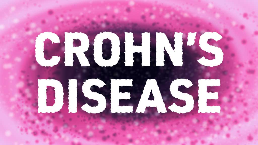 Cover image for: Crohn's Disease