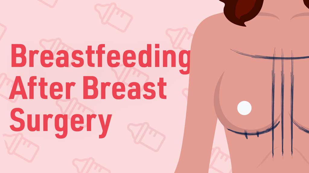 Cover image for: Breastfeeding After Breast Reduction or Augmentation Surgery