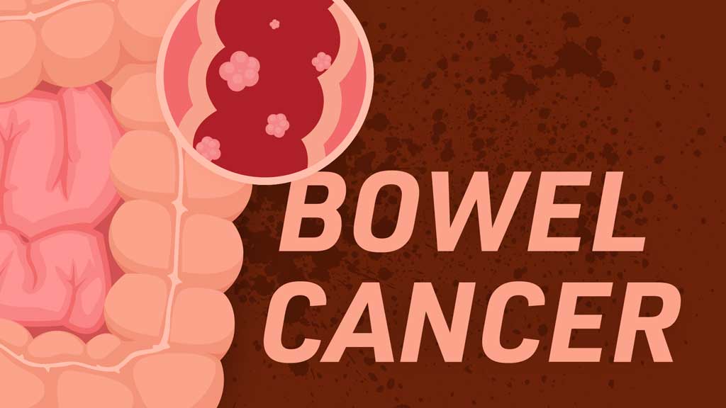 Cover image for: Bowel (Colorectal) Cancer and Care