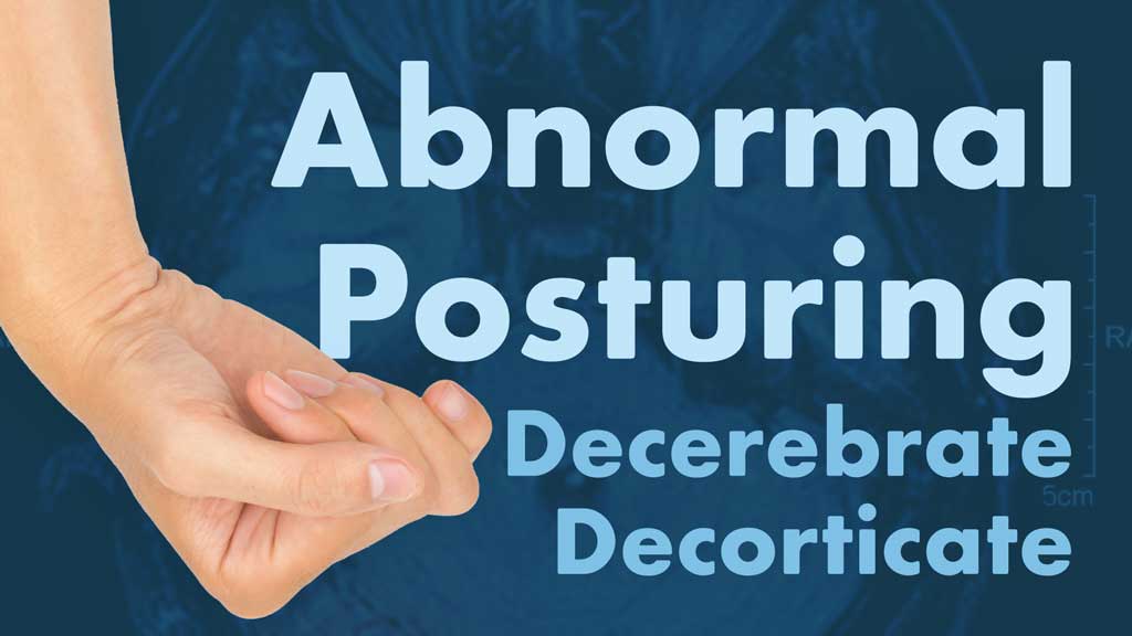 Cover image for: Abnormal Posturing (Decerebrate and Decorticate)