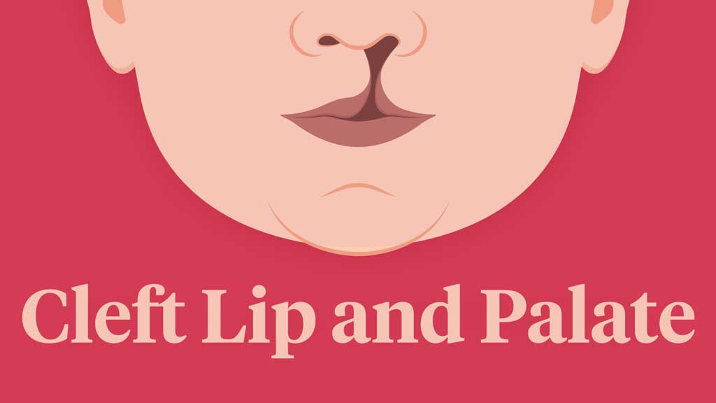 Cover image for: Cleft Lip and Palate