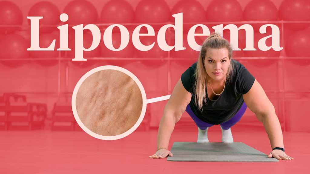 Cover image for: An Introduction to Lipoedema
