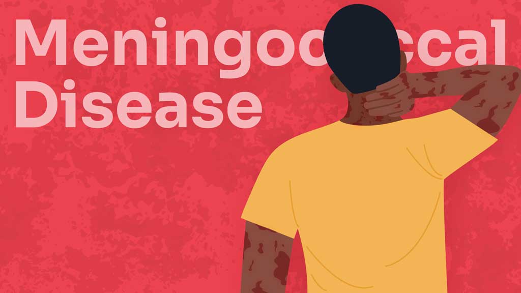 Cover image for: Meningococcal Disease