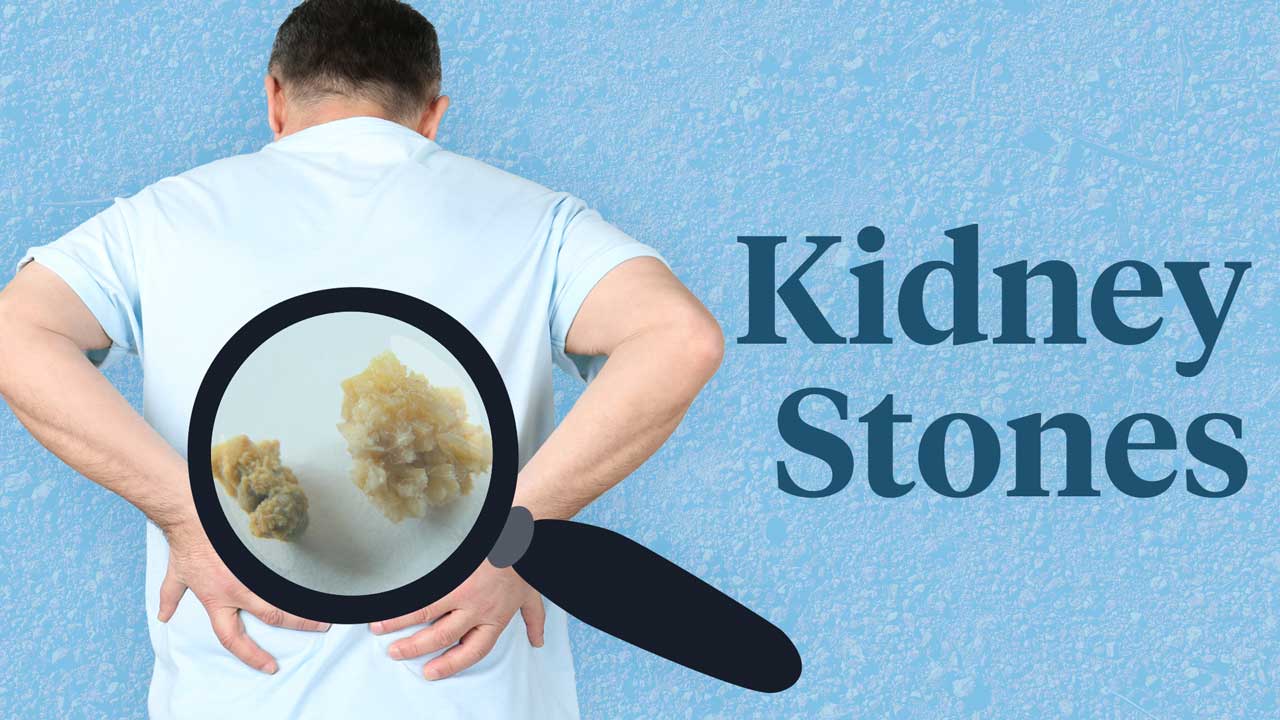 Cover image for: Kidney Stones