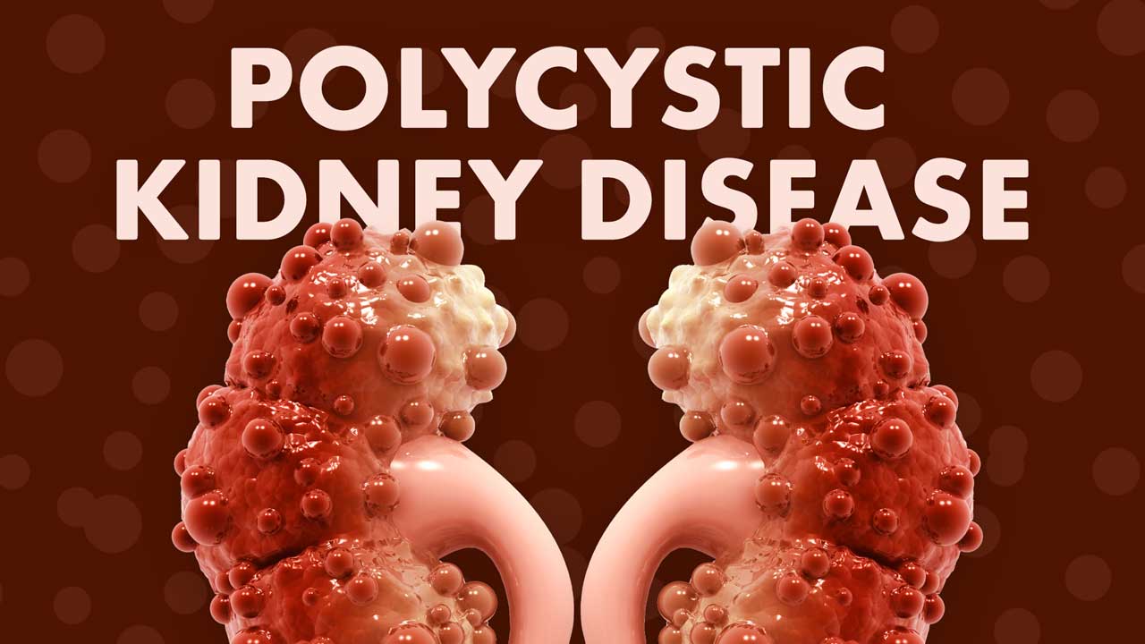 Image for Polycystic Kidney Disease