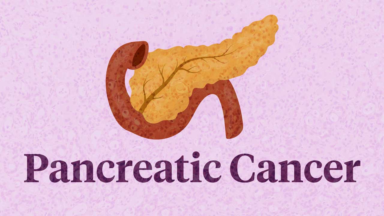 Cover image for: Pancreatic Cancer
