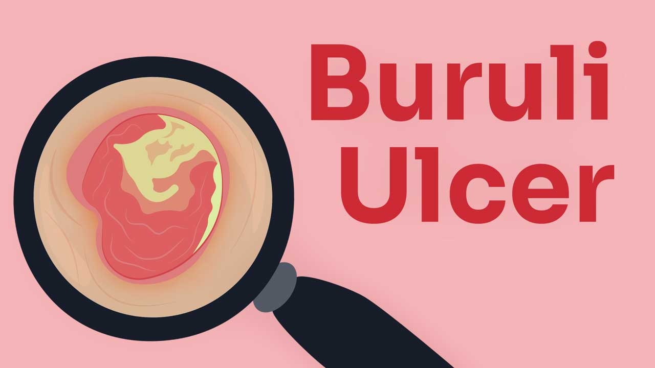 Cover image for: Buruli Ulcer: A ‘Flesh-Eating’ Infection